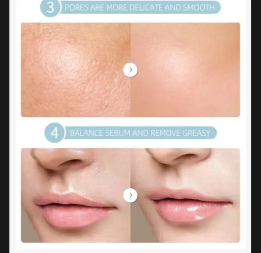 Retinol Serum for Acne Prone Skin Buy 1 Get 1 Free